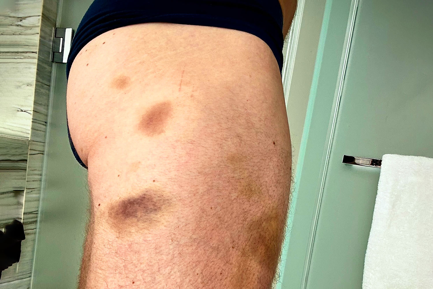 Bruises on Neil Patrick Harris's leg